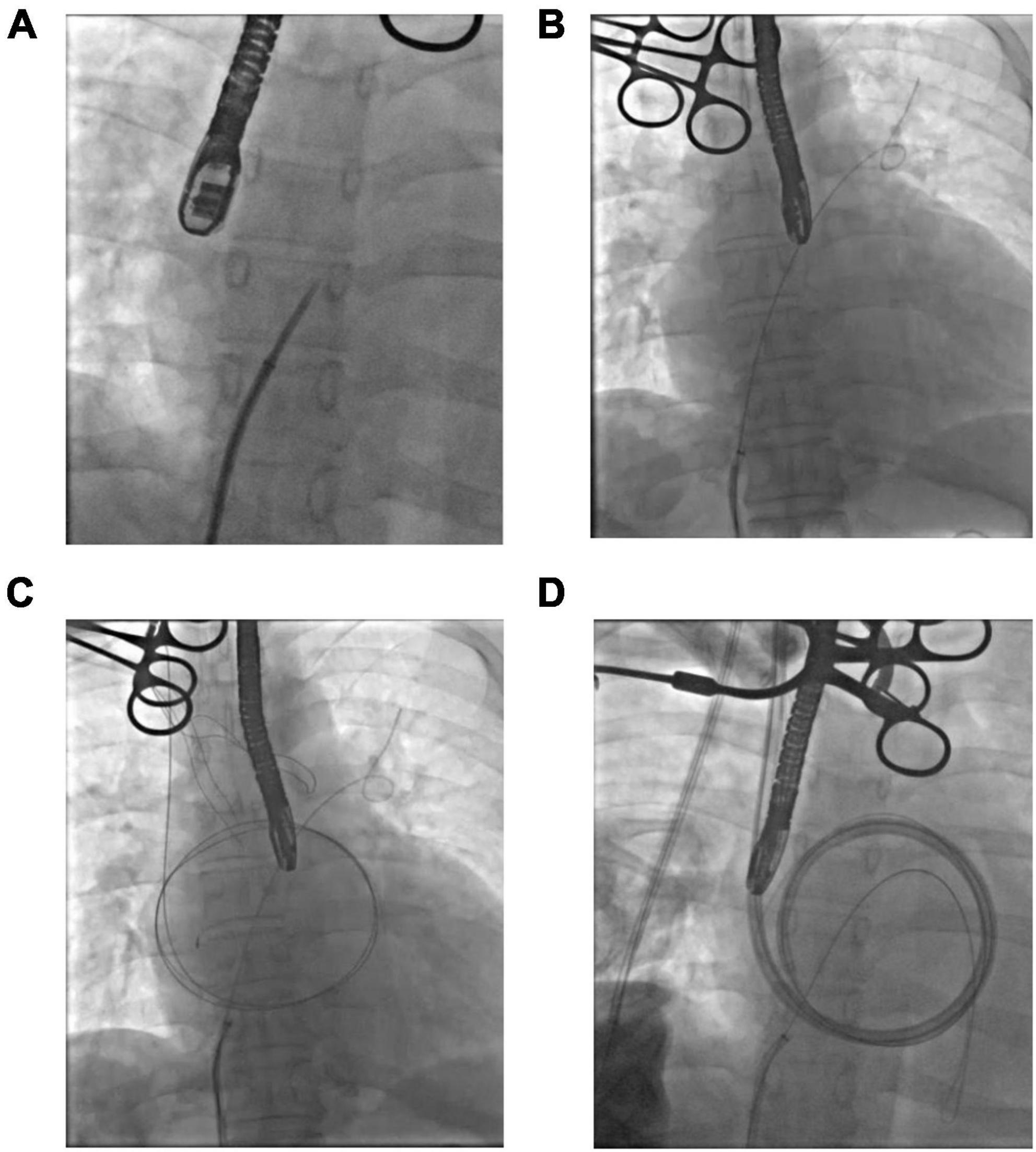 Case report: Successful percutaneous extracorporeal magnetic levitation ventricular assist device support in a patient with left heart failure due to dilated cardiomyopathy